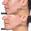 image:imageSunday Riley Peacekeeper Azaleic and Salicylic Acid Acne Treatment SerumOff White