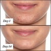 image:imageSunday Riley UFO UltraClarifying Salicylic Acid and Tea Tree Acne Treatment Face Oil05 Fl Oz Pack of 1